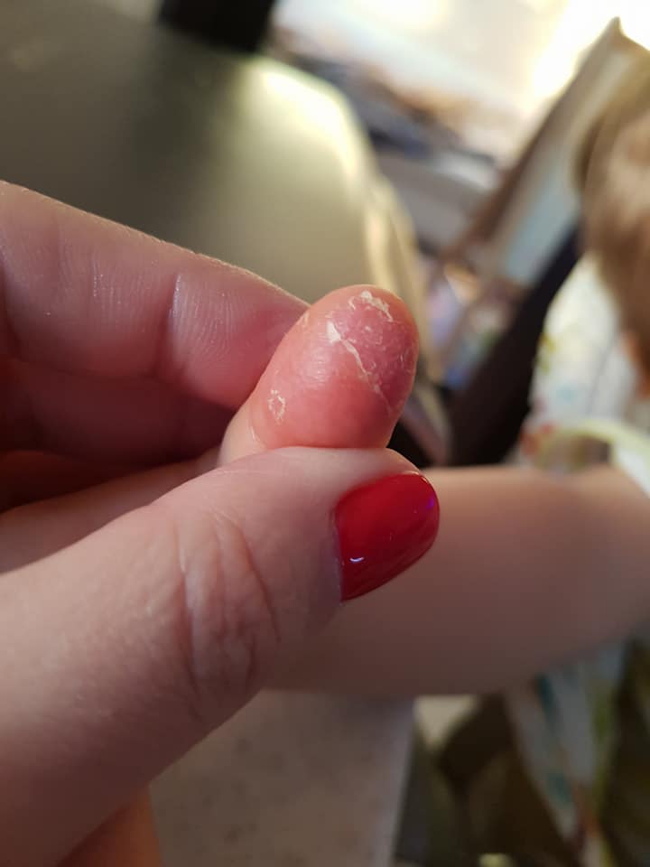 Почему на пальцах рук ребенка облазит кожа?