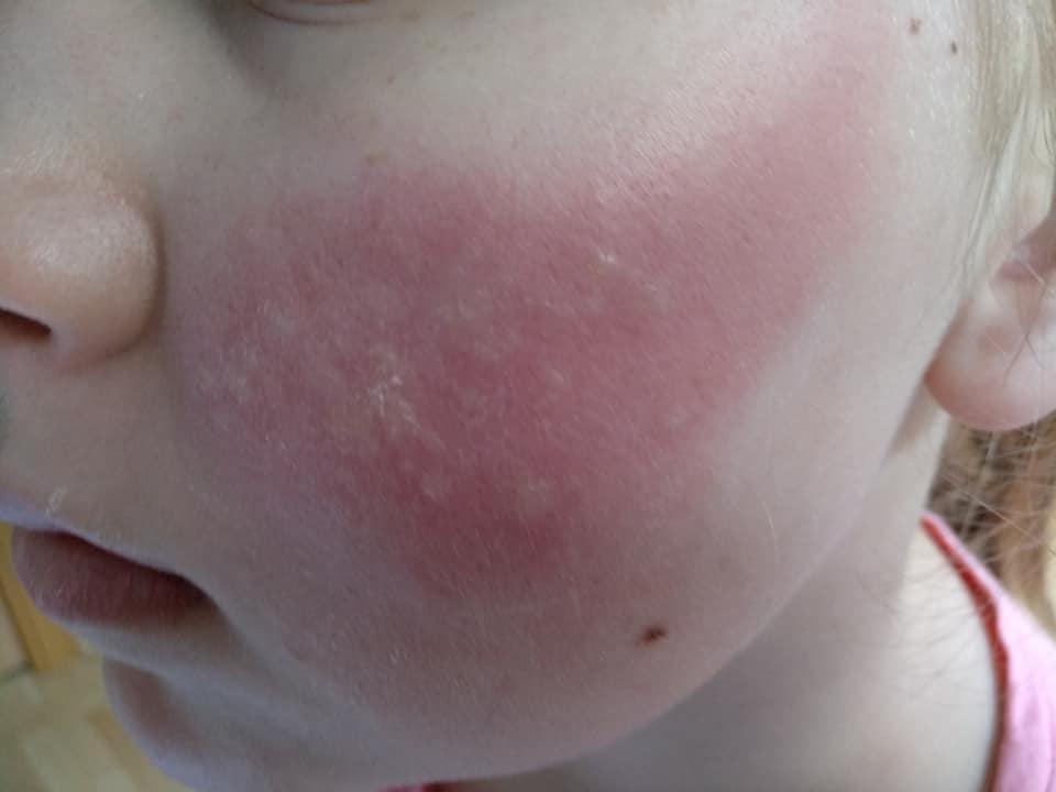 Аллергия На Пантенол