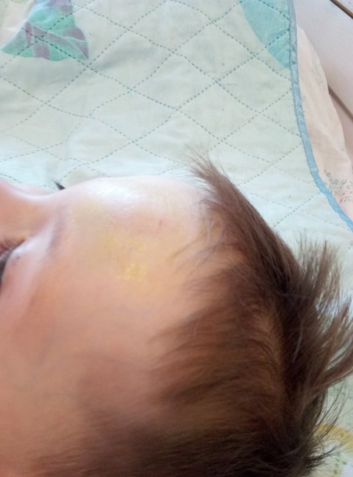 Ребенок в 7 месяцев упал с кровати шишка на лбу
