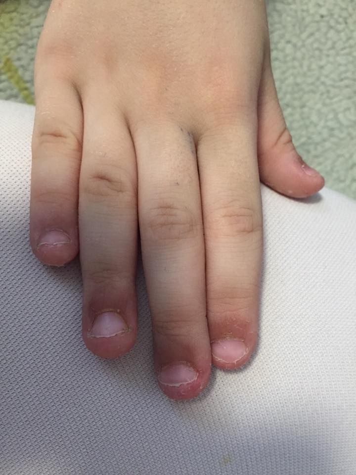 У ребенка шелушится кожа на пальцах рук и стоп