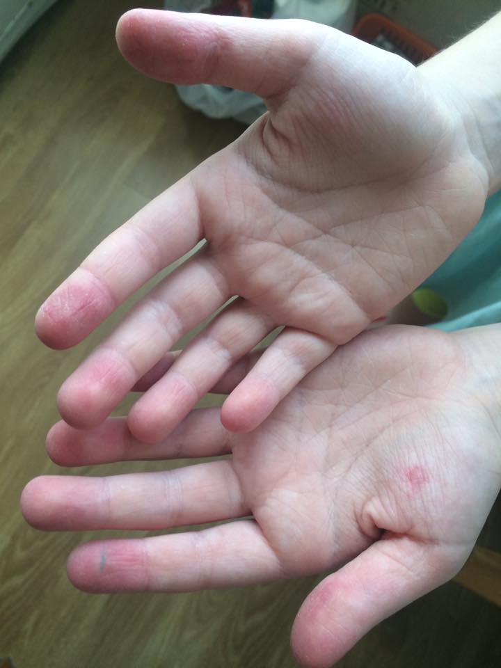 Что делать, если на пальцах рук ребенка слезает кожа